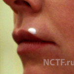 Анестетик на верхней губе перед уколом ботокса